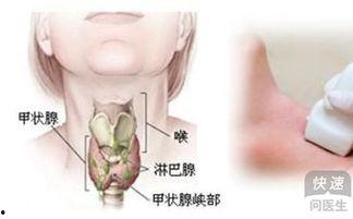 甲亢吃角瓜好吗